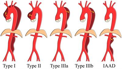 Natural history of isolated abdominal aortic dissection: A prospective cohort study